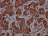 IHC image of CSB-RA919798A0HU diluted at 1:100 and staining in paraffin-embedded human breast cancer performed on a Leica BondTM system. After dewaxing and hydration, antigen retrieval was mediated by high pressure in a citrate buffer (pH 6.0). Section was blocked with 10% normal goat serum 30min at RT. Then primary antibody (1% BSA) was incubated at 4°C overnight. The primary is detected by a Goat anti-rabbit IgG polymer labeled by HRP and visualized using 0.05% DAB.