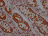 IHC image of CSB-RA919798A0HU diluted at 1:100 and staining in paraffin-embedded human colon cancer performed on a Leica BondTM system. After dewaxing and hydration, antigen retrieval was mediated by high pressure in a citrate buffer (pH 6.0). Section was blocked with 10% normal goat serum 30min at RT. Then primary antibody (1% BSA) was incubated at 4°C overnight. The primary is detected by a Goat anti-rabbit IgG polymer labeled by HRP and visualized using 0.05% DAB.