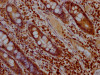 IHC image of CSB-RA187762A0HU diluted at 1:100 and staining in paraffin-embedded human colon cancer performed on a Leica BondTM system. After dewaxing and hydration, antigen retrieval was mediated by high pressure in a citrate buffer (pH 6.0). Section was blocked with 10% normal goat serum 30min at RT. Then primary antibody (1% BSA) was incubated at 4°C overnight. The primary is detected by a Goat anti-rabbit IgG polymer labeled by HRP and visualized using 0.05% DAB.
