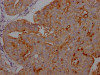 IHC image of CSB-RA941216A0HU diluted at 1:100 and staining in paraffin-embedded human endometrial cancer performed on a Leica BondTM system. After dewaxing and hydration, antigen retrieval was mediated by high pressure in a citrate buffer (pH 6.0). Section was blocked with 10% normal goat serum 30min at RT. Then primary antibody (1% BSA) was incubated at 4°C overnight. The primary is detected by a Goat anti-rabbit IgG polymer labeled by HRP and visualized using 0.05% DAB.
