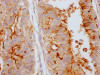 IHC image of CSB-RA973154A0HU diluted at 1:100 and staining in paraffin-embedded human endometrial cancer performed on a Leica BondTM system. After dewaxing and hydration, antigen retrieval was mediated by high pressure in a citrate buffer (pH 6.0). Section was blocked with 10% normal goat serum 30min at RT. Then primary antibody (1% BSA) was incubated at 4°C overnight. The primary is detected by a Goat anti-rabbit IgG polymer labeled by HRP and visualized using 0.05% DAB.