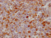 IHC image of CSB-RA909932A0HU diluted at 1:100 and staining in paraffin-embedded human lung cancer performed on a Leica BondTM system. After dewaxing and hydration, antigen retrieval was mediated by high pressure in a citrate buffer (pH 6.0). Section was blocked with 10% normal goat serum 30min at RT. Then primary antibody (1% BSA) was incubated at 4°C overnight. The primary is detected by a Goat anti-rabbit IgG polymer labeled by HRP and visualized using 0.05% DAB.