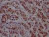 IHC image of CSB-RA196111A0HU diluted at 1:100 and staining in paraffin-embedded human breast cancer performed on a Leica BondTM system. After dewaxing and hydration, antigen retrieval was mediated by high pressure in a citrate buffer (pH 6.0). Section was blocked with 10% normal goat serum 30min at RT. Then primary antibody (1% BSA) was incubated at 4°C overnight. The primary is detected by a Goat anti-rabbit IgG polymer labeled by HRP and visualized using 0.05% DAB.