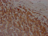 IHC image of CSB-RA595609A0HU diluted at 1:100 and staining in paraffin-embedded human breast cancer performed on a Leica BondTM system. After dewaxing and hydration, antigen retrieval was mediated by high pressure in a citrate buffer (pH 6.0). Section was blocked with 10% normal goat serum 30min at RT. Then primary antibody (1% BSA) was incubated at 4°C overnight. The primary is detected by a Goat anti-rabbit IgG polymer labeled by HRP and visualized using 0.05% DAB.