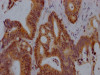 IHC image of CSB-RA945260A0HU diluted at 1:100 and staining in paraffin-embedded human colon cancer performed on a Leica BondTM system. After dewaxing and hydration, antigen retrieval was mediated by high pressure in a citrate buffer (pH 6.0). Section was blocked with 10% normal goat serum 30min at RT. Then primary antibody (1% BSA) was incubated at 4°C overnight. The primary is detected by a Goat anti-rabbit IgG polymer labeled by HRP and visualized using 0.05% DAB.