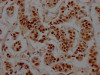 IHC image of CSB-RA915915A0HU diluted at 1:100 and staining in paraffin-embedded human breast cancer performed on a Leica BondTM system. After dewaxing and hydration, antigen retrieval was mediated by high pressure in a citrate buffer (pH 6.0). Section was blocked with 10% normal goat serum 30min at RT. Then primary antibody (1% BSA) was incubated at 4°C overnight. The primary is detected by a Goat anti-rabbit IgG polymer labeled by HRP and visualized using 0.05% DAB.