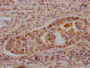 IHC image of CSB-RA799763A0HU diluted at 1:100 and staining in paraffin-embedded human liver cancer performed on a Leica BondTM system. After dewaxing and hydration, antigen retrieval was mediated by high pressure in a citrate buffer (pH 6.0). Section was blocked with 10% normal goat serum 30min at RT. Then primary antibody (1% BSA) was incubated at 4°C overnight. The primary is detected by a Goat anti-rabbit IgG polymer labeled by HRP and visualized using 0.05% DAB.