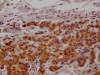 IHC image of CSB-RA990134A0HU diluted at 1:100 and staining in paraffin-embedded human breast cancer performed on a Leica BondTM system. After dewaxing and hydration, antigen retrieval was mediated by high pressure in a citrate buffer (pH 6.0). Section was blocked with 10% normal goat serum 30min at RT. Then primary antibody (1% BSA) was incubated at 4°C overnight. The primary is detected by a Goat anti-rabbit IgG polymer labeled by HRP and visualized using 0.05% DAB.