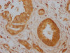 IHC image of CSB-RA177985A0HU diluted at 1:100 and staining in paraffin-embedded human pancreatic cancer performed on a Leica BondTM system. After dewaxing and hydration, antigen retrieval was mediated by high pressure in a citrate buffer (pH 6.0). Section was blocked with 10% normal goat serum 30min at RT. Then primary antibody (1% BSA) was incubated at 4°C overnight. The primary is detected by a Goat anti-rabbit IgG polymer labeled by HRP and visualized using 0.05% DAB.