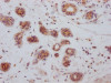 IHC image of CSB-RA247982A0HU diluted at 1:100 and staining in paraffin-embedded human breast cancer performed on a Leica BondTM system. After dewaxing and hydration, antigen retrieval was mediated by high pressure in a citrate buffer (pH 6.0). Section was blocked with 10% normal goat serum 30min at RT. Then primary antibody (1% BSA) was incubated at 4°C overnight. The primary is detected by a Goat anti-rabbit IgG polymer labeled by HRP and visualized using 0.05% DAB.