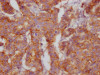 IHC image of CSB-RA908548A0HU diluted at 1:100 and staining in paraffin-embedded human breast cancer performed on a Leica BondTM system. After dewaxing and hydration, antigen retrieval was mediated by high pressure in a citrate buffer (pH 6.0). Section was blocked with 10% normal goat serum 30min at RT. Then primary antibody (1% BSA) was incubated at 4°C overnight. The primary is detected by a Goat anti-rabbit IgG polymer labeled by HRP and visualized using 0.05% DAB.