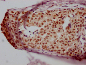 IHC image of CSB-RA988421A0HU diluted at 1:100 and staining in paraffin-embedded human breast cancer performed on a Leica BondTM system. After dewaxing and hydration, antigen retrieval was mediated by high pressure in a citrate buffer (pH 6.0). Section was blocked with 10% normal goat serum 30min at RT. Then primary antibody (1% BSA) was incubated at 4°C overnight. The primary is detected by a Goat anti-rabbit IgG polymer labeled by HRP and visualized using 0.05% DAB.