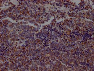 IHC image of CSB-RA218127A0HU diluted at 1:100 and staining in paraffin-embedded human lung cancer performed on a Leica BondTM system. After dewaxing and hydration, antigen retrieval was mediated by high pressure in a citrate buffer (pH 6.0). Section was blocked with 10% normal goat serum 30min at RT. Then primary antibody (1% BSA) was incubated at 4°C overnight. The primary is detected by a Goat anti-rabbit IgG polymer labeled by HRP and visualized using 0.05% DAB.