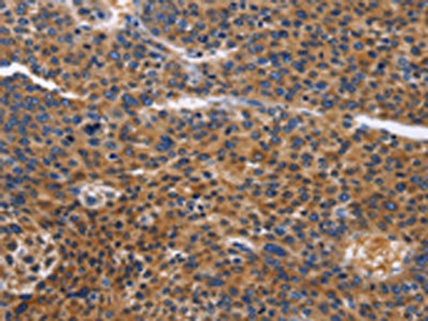 The image on the left is immunohistochemistry of paraffin-embedded Human liver cancer tissue using CSB-PA206692 (ACVR2B Antibody) at dilution 1/50, on the right is treated with fusion protein. (Original magnification: ×200) The image on the left is immunohistochemistry of paraffin-embedded Human liver cancer tissue using CSB-PA206692 (ACVR2B Antibody) at dilution 1/50, on the right is treated with fusion protein. (Original magnification: ×200)