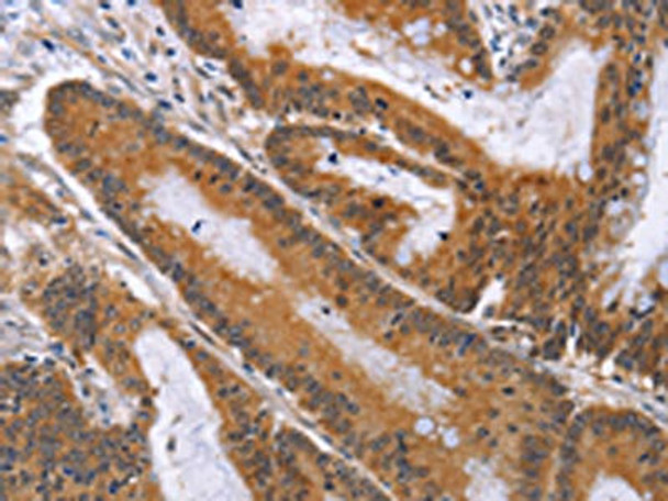 The image on the left is immunohistochemistry of paraffin-embedded Human colon cancer tissue using CSB-PA206692 (ACVR2B Antibody) at dilution 1/50, on the right is treated with fusion protein. (Original magnification: ×200) The image on the left is immunohistochemistry of paraffin-embedded Human colon cancer tissue using CSB-PA206692 (ACVR2B Antibody) at dilution 1/50, on the right is treated with fusion protein. (Original magnification: ×200)