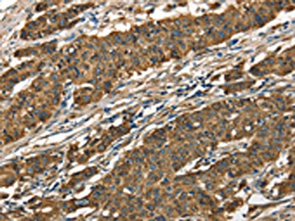 The image on the left is immunohistochemistry of paraffin-embedded Human gastic cancer tissue using CSB-PA296813 (CTSE Antibody) at dilution 1/40, on the right is treated with fusion protein. (Original magnification: ×200) The image on the left is immunohistochemistry of paraffin-embedded Human gastic cancer tissue using CSB-PA296813 (CTSE Antibody) at dilution 1/40, on the right is treated with fusion protein. (Original magnification: ×200)