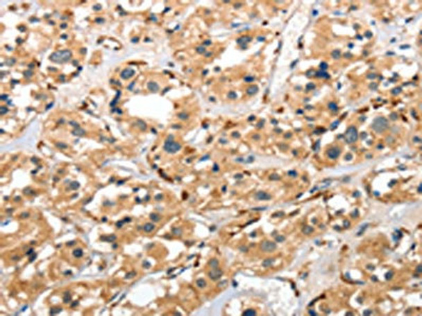 The image on the left is immunohistochemistry of paraffin-embedded Human thyroid cancer tissue using CSB-PA296813 (CTSE Antibody) at dilution 1/40, on the right is treated with fusion protein. (Original magnification: ×200) The image on the left is immunohistochemistry of paraffin-embedded Human thyroid cancer tissue using CSB-PA296813 (CTSE Antibody) at dilution 1/40, on the right is treated with fusion protein. (Original magnification: ×200)
