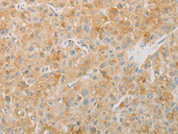 The image on the left is immunohistochemistry of paraffin-embedded Human liver cancer tissue using CSB-PA973928 (AES Antibody) at dilution 1/20, on the right is treated with fusion protein. (Original magnification: ×200) The image on the left is immunohistochemistry of paraffin-embedded Human liver cancer tissue using CSB-PA973928 (AES Antibody) at dilution 1/20, on the right is treated with fusion protein. (Original magnification: ×200)