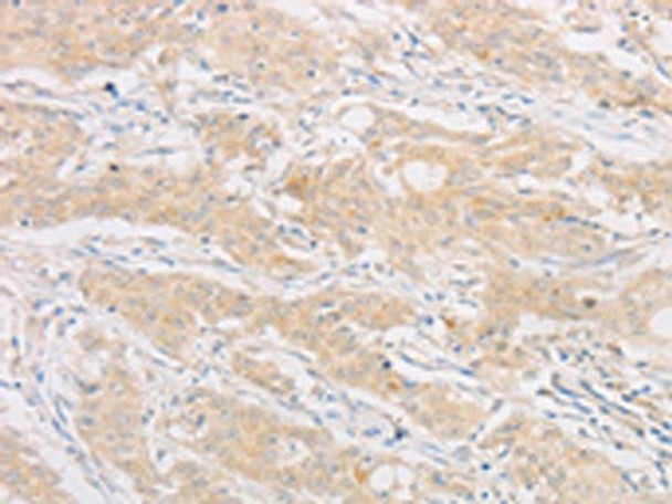 The image on the left is immunohistochemistry of paraffin-embedded Human gastric cancer tissue using CSB-PA973928 (AES Antibody) at dilution 1/20, on the right is treated with fusion protein. (Original magnification: ×200) The image on the left is immunohistochemistry of paraffin-embedded Human gastric cancer tissue using CSB-PA973928 (AES Antibody) at dilution 1/20, on the right is treated with fusion protein. (Original magnification: ×200)
