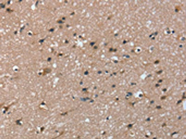 The image on the left is immunohistochemistry of paraffin-embedded Human brain tissue using CSB-PA290336 (TRIM31 Antibody) at dilution 1/20, on the right is treated with fusion protein. (Original magnification: ×200) The image on the left is immunohistochemistry of paraffin-embedded Human brain tissue using CSB-PA290336 (TRIM31 Antibody) at dilution 1/20, on the right is treated with fusion protein. (Original magnification: ×200)