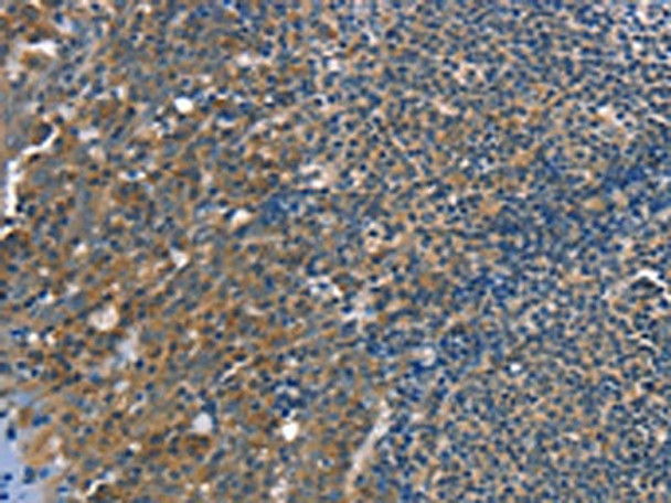 The image on the left is immunohistochemistry of paraffin-embedded Human tonsil tissue using CSB-PA290336 (TRIM31 Antibody) at dilution 1/20, on the right is treated with fusion protein. (Original magnification: ×200) The image on the left is immunohistochemistry of paraffin-embedded Human tonsil tissue using CSB-PA290336 (TRIM31 Antibody) at dilution 1/20, on the right is treated with fusion protein. (Original magnification: ×200)