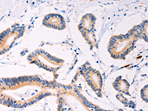 The image on the left is immunohistochemistry of paraffin-embedded Human colon cancer tissue using CSB-PA065885 (PLIN2 Antibody) at dilution 1/20, on the right is treated with synthetic peptide. (Original magnification: ×200) The image on the left is immunohistochemistry of paraffin-embedded Human colon cancer tissue using CSB-PA065885 (PLIN2 Antibody) at dilution 1/20, on the right is treated with synthetic peptide. (Original magnification: ×200)