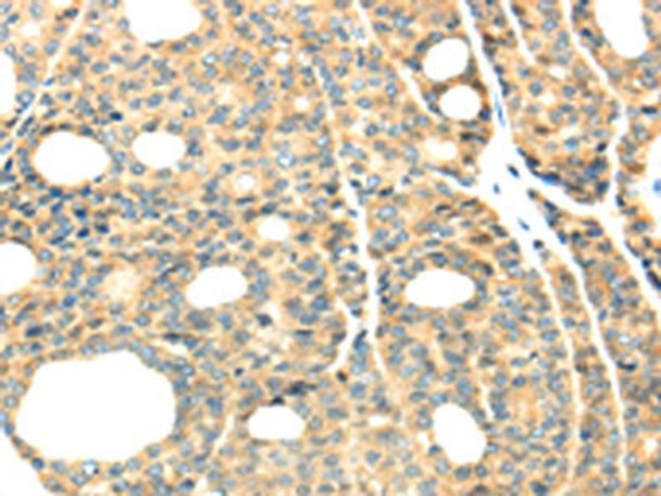 The image on the left is immunohistochemistry of paraffin-embedded Human thyroid cancer tissue using CSB-PA930884 (TTBK2 Antibody) at dilution 1/40, on the right is treated with synthetic peptide. (Original magnification: ×200) The image on the left is immunohistochemistry of paraffin-embedded Human thyroid cancer tissue using CSB-PA930884 (TTBK2 Antibody) at dilution 1/40, on the right is treated with synthetic peptide. (Original magnification: ×200)