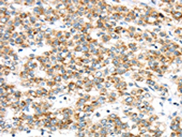 The image on the left is immunohistochemistry of paraffin-embedded Human liver cancer tissue using CSB-PA930884 (TTBK2 Antibody) at dilution 1/40, on the right is treated with synthetic peptide. (Original magnification: ×200) The image on the left is immunohistochemistry of paraffin-embedded Human liver cancer tissue using CSB-PA930884 (TTBK2 Antibody) at dilution 1/40, on the right is treated with synthetic peptide. (Original magnification: ×200)
