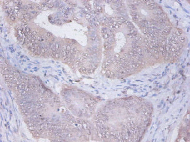 Immunohistochemistry of paraffin-embedded human colon cancer using CSB-PA02925A0Rb at dilution of 1:100 Immunohistochemistry of paraffin-embedded human colon cancer using CSB-PA02925A0Rb at dilution of 1:100