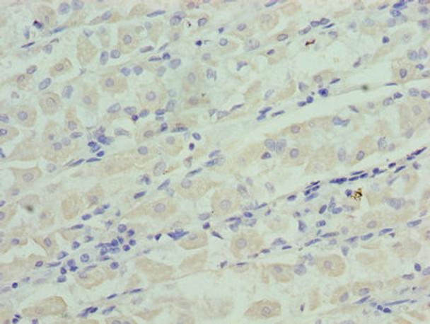 Immunohistochemistry of paraffin-embedded human gastric cancer using CSB-PA08419A0Rb at dilution of 1:100 Immunohistochemistry of paraffin-embedded human gastric cancer using CSB-PA08419A0Rb at dilution of 1:100