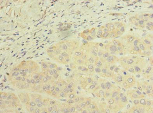 Immunohistochemistry of paraffin-embedded human liver cancer using CSB-PA840978LA01HU at dilution of 1:100 Immunohistochemistry of paraffin-embedded human liver cancer using CSB-PA840978LA01HU at dilution of 1:100