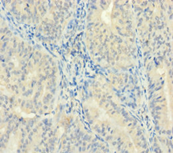 Immunohistochemistry of paraffin-embedded human endometrial cancer using CSB-PA866211LA01HU at dilution of 1:100 Immunohistochemistry of paraffin-embedded human endometrial cancer using CSB-PA866211LA01HU at dilution of 1:100