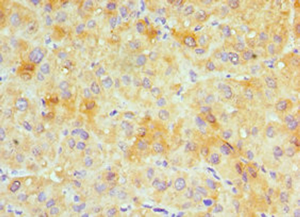 Immunohistochemistry of paraffin-embedded human liver cancer using CSB-PA009458ESR2HU at dilution of 1:100 Immunohistochemistry of paraffin-embedded human liver cancer using CSB-PA009458ESR2HU at dilution of 1:100