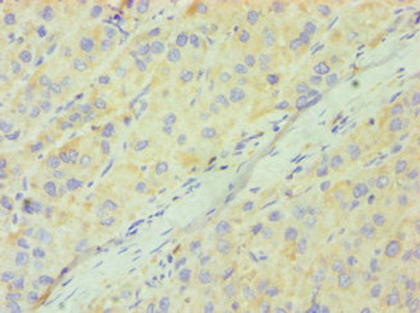 Immunohistochemistry of paraffin-embedded human liver cancer using CSB-PA004925ESR2HU at dilution of 1:100 Immunohistochemistry of paraffin-embedded human liver cancer using CSB-PA004925ESR2HU at dilution of 1:100