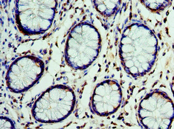 Immunohistochemistry of paraffin-embedded human colon cancer using CSB-PA006095ESR2HU at dilution of 1:100 Immunohistochemistry of paraffin-embedded human colon cancer using CSB-PA006095ESR2HU at dilution of 1:100