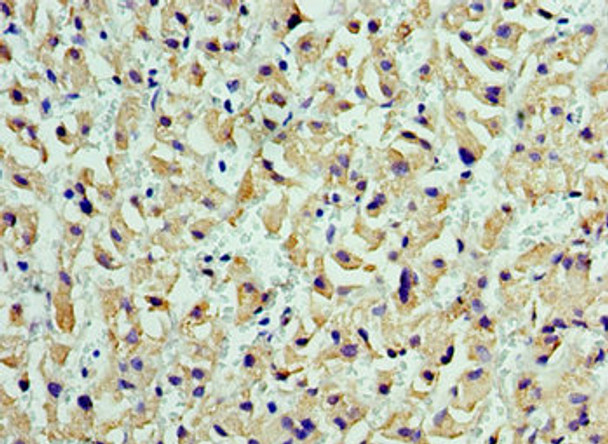 Immunohistochemistry of paraffin-embedded human liver cancer using CSB-PA006095ESR2HU at dilution of 1:100 Immunohistochemistry of paraffin-embedded human liver cancer using CSB-PA006095ESR2HU at dilution of 1:100