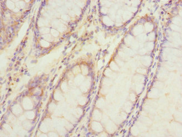 Immunohistochemistry of paraffin-embedded human colon cancer using CSB-PA881016ESR2HU at dilution of 1:100 Immunohistochemistry of paraffin-embedded human colon cancer using CSB-PA881016ESR2HU at dilution of 1:100