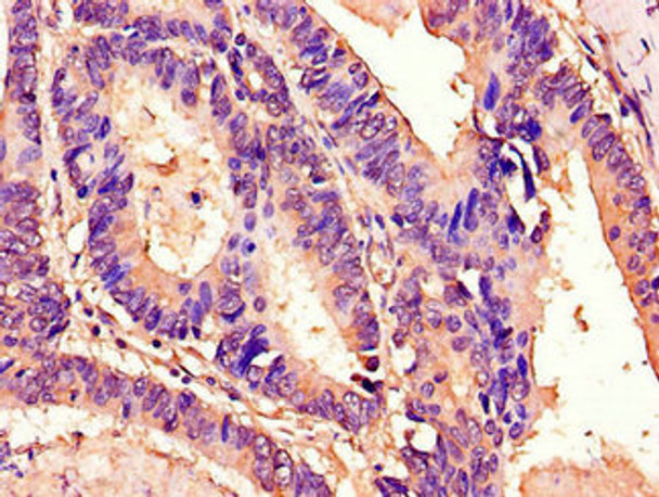 Immunohistochemistry of paraffin-embedded human colon cancer using CSB-PA709608LA01HU at dilution of 1:100 Immunohistochemistry of paraffin-embedded human colon cancer using CSB-PA709608LA01HU at dilution of 1:100