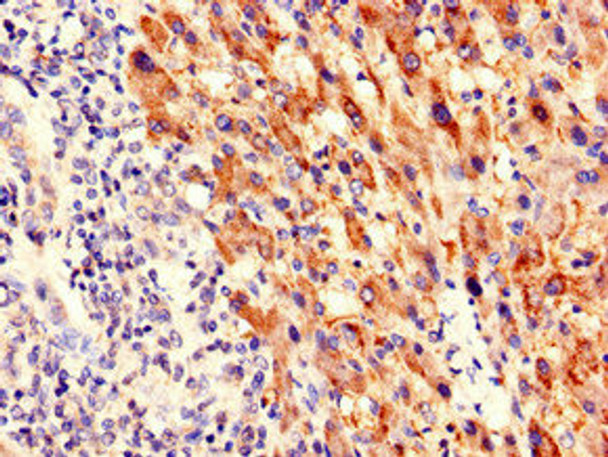 Immunohistochemistry of paraffin-embedded human liver cancer using CSB-PA771444LA01HU at dilution of 1:100 Immunohistochemistry of paraffin-embedded human liver cancer using CSB-PA771444LA01HU at dilution of 1:100