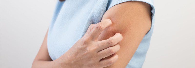 Natural Ways to Ditch the Itch from Eczema