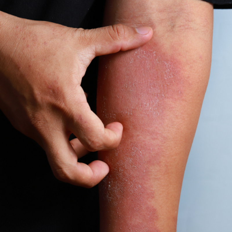 6 Commonly Asked Questions About Psoriasis