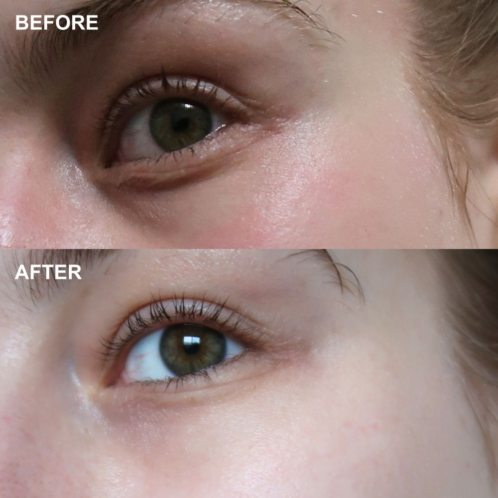 Wrinkles Shminkles Self-Dissolving Microneedle Patches