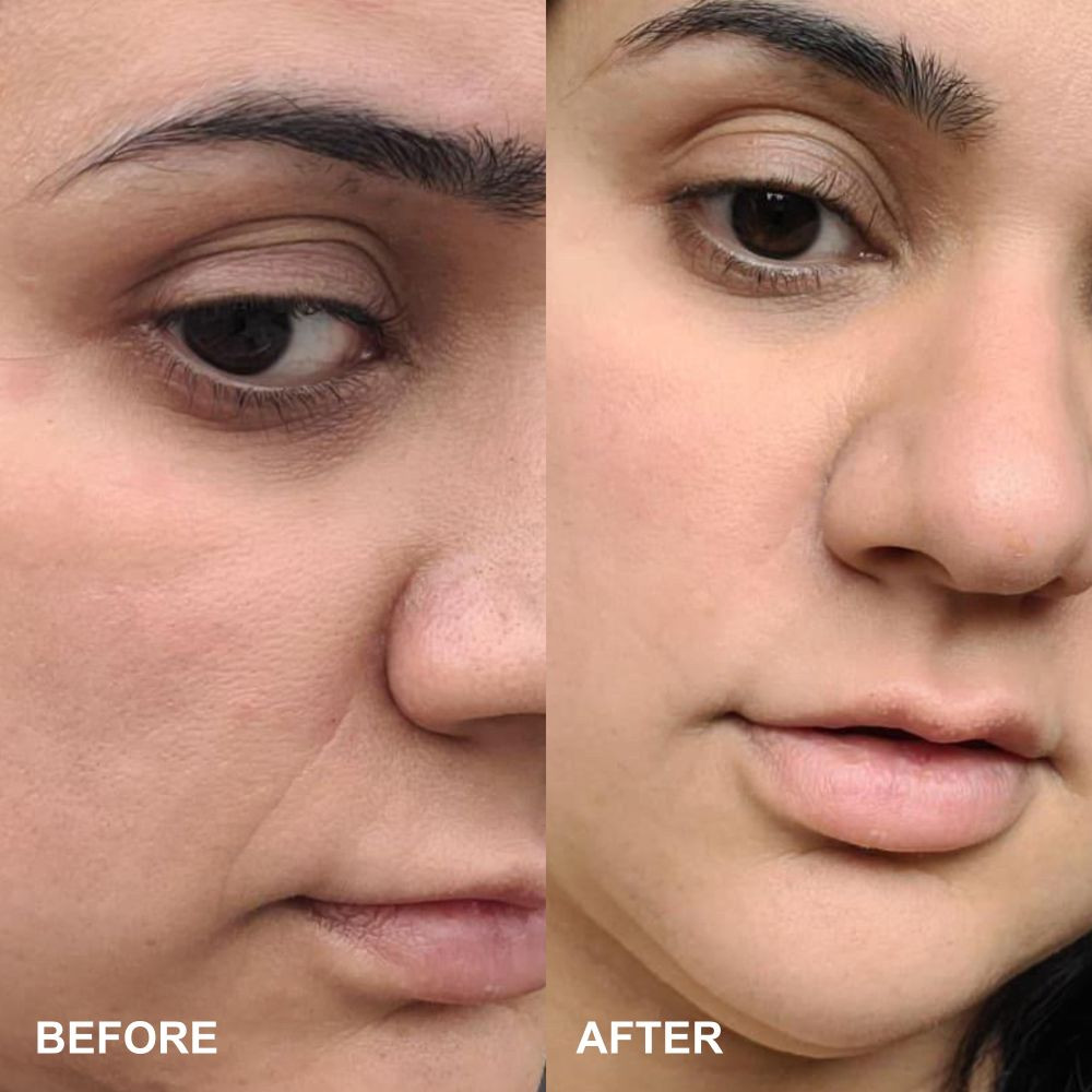 Wrinkles Shminkles Self-Dissolving Microneedle Patches Wrinkles Shminkles Self-Dissolving Microneedle Patches