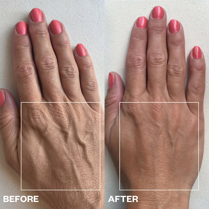 Wrinkles Shminkles Hand Wrinkle Patches