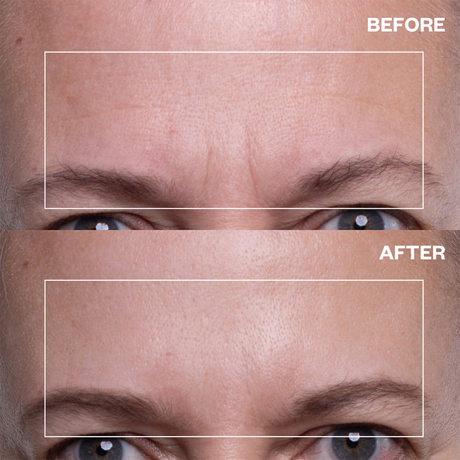 Wrinkles Shminkles Forehead Wrinkle Patch - Single