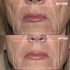 Wrinkles Shminkles Mouth & Lip Wrinkle Patches