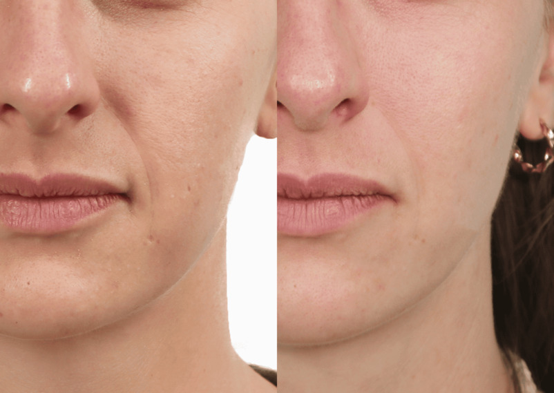 Before/after
