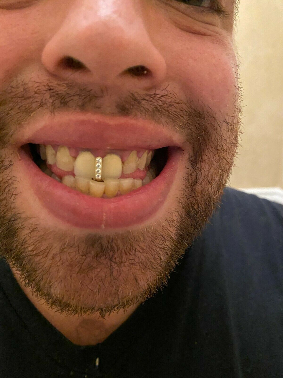 Single Cap Grillz 