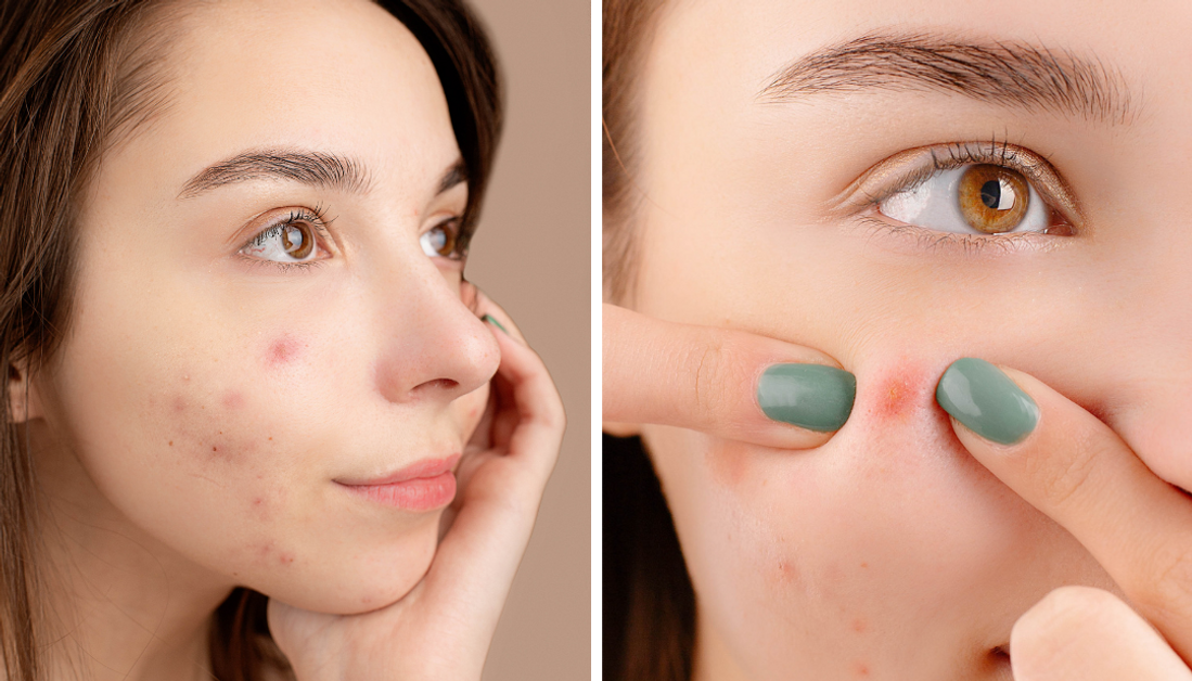 Hemp Seed Lotion for Acne-Prone Skin: The Natural Solution to Clearer Complexion Hemp Seed Lotion for Acne-Prone Skin: The Natural Solution to Clearer Complexion