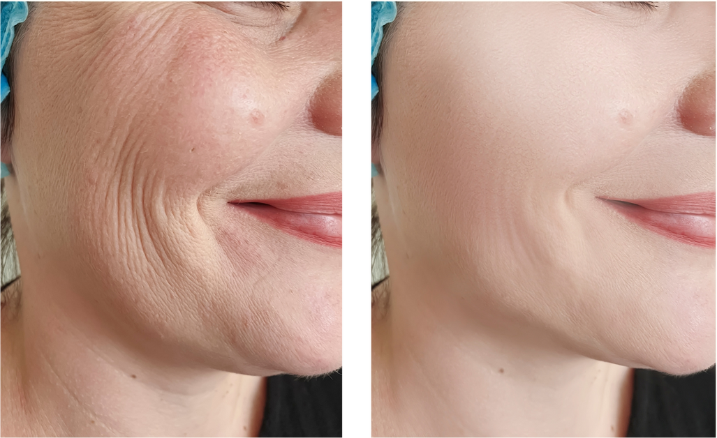 Hemp seed Lotion for Reducing the Appearance of Fine Lines and Wrinkles Hemp seed Lotion for Reducing the Appearance of Fine Lines and Wrinkles